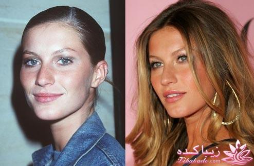 جراحی بینی - جراحی زیبایی